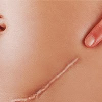 Post image for Lowering the Risk and Severity of Scarring after Surgery