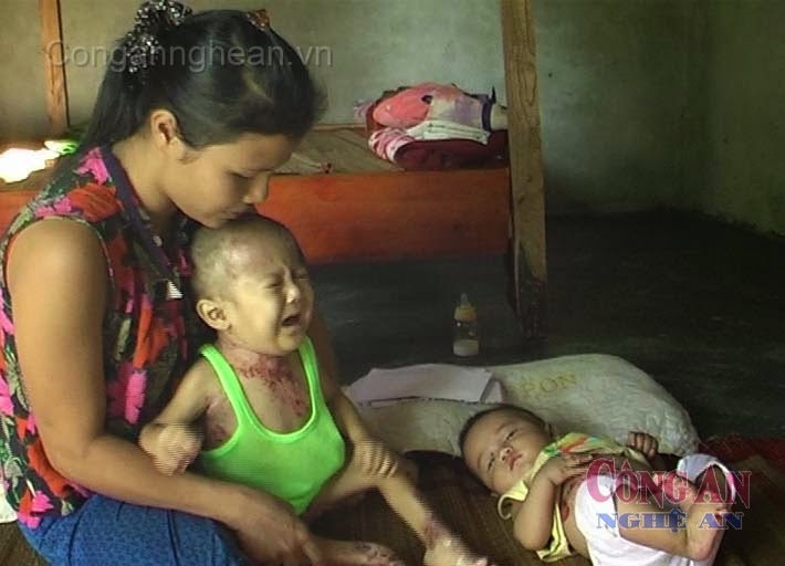 Hai bé Phúc, Lộc đang từng ngày chiến đấu với bệnh tật, giành giật sự sống