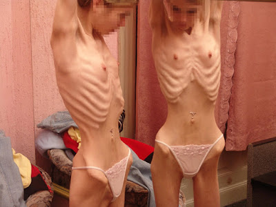 A triste e falsa beleza da anorexia - Parte 3