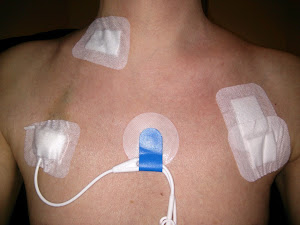 Hickman Line - Insertion & Removal - Dressings