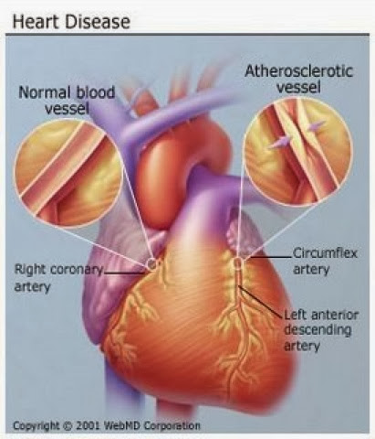 coronary artery disease and diabetes mellitus Type 2 diabetes mellitus (t2dm) is a major risk factor of coronary artery diseases (cad) clinical outcomes in cad with t2dm are poor despite improvement in medications and intervention devices. coronary artery disease and diabetes mellitus Type 2 diabetes mellitus (t2dm) is a major risk factor of coronary artery diseases (cad) clinical outcomes in cad with t2dm are poor despite improvement in medications and intervention devices.