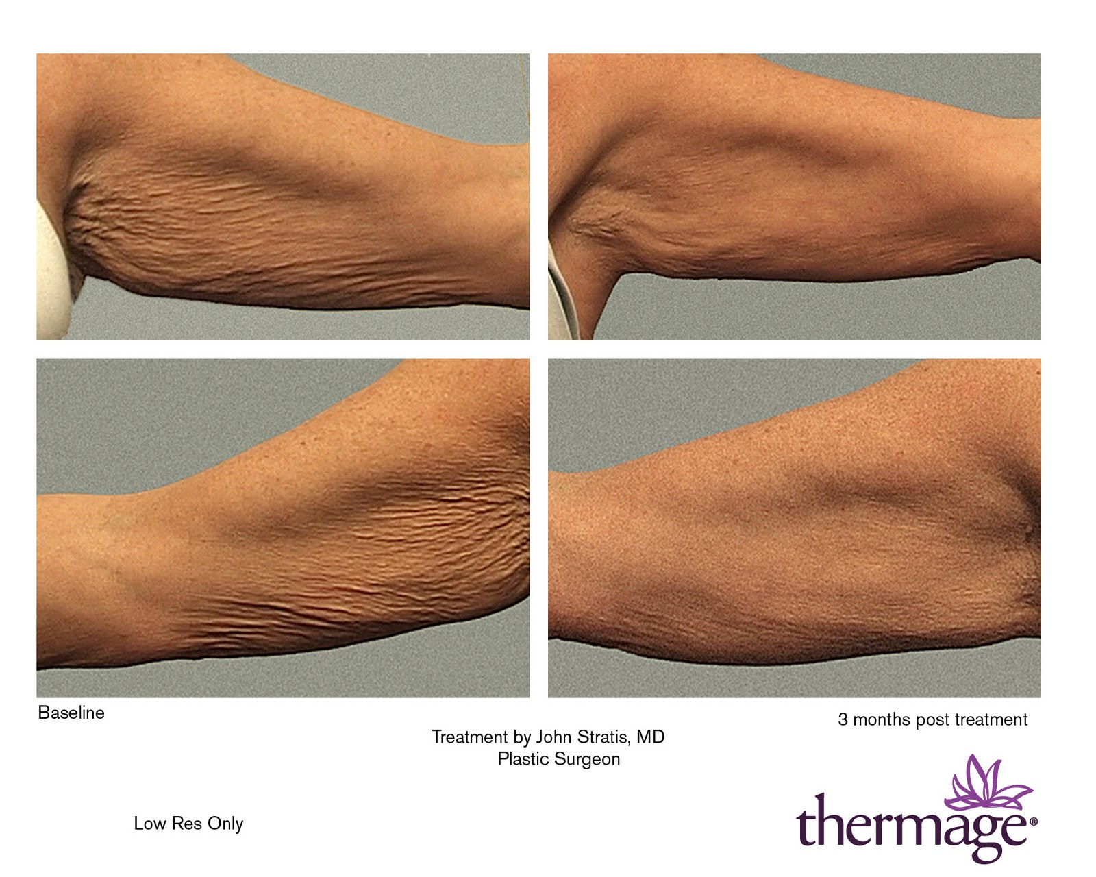 Thermage skin tightening on the Face, Arms, Thighs Seattle Soap Company