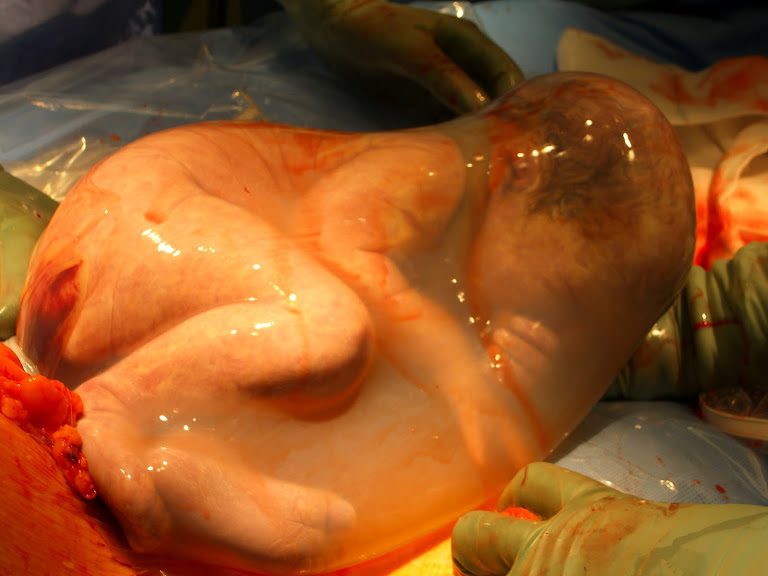 10 Extraordinary Photos of Babies Born in the Amniotic Sac