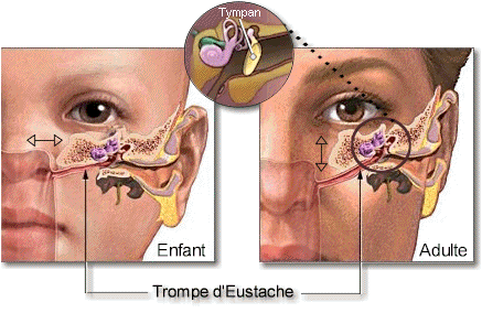 comment soigner otite chez bebe