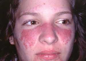 penyakit lupus Lupus : Penyakit dengan seribu wajah