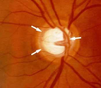 glaukoma-disku