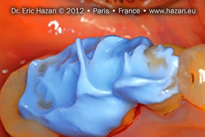 Vérification des volumes au niveau occlusal. Docteur Eric Hazan, chirurgien-dentiste / dental surgeon, Paris 16, France