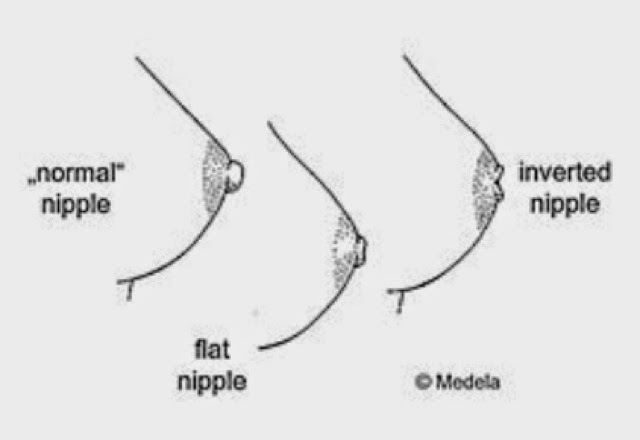 flat nipple vs inverted nipple