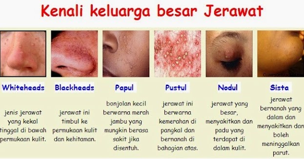 Ubat Jerawat Yang Berkesan Di Farmasi - Terbaru 10