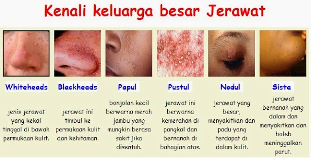 Kulit Kembali Licin Dengan Vivix Selepas Menderita Jerawat 