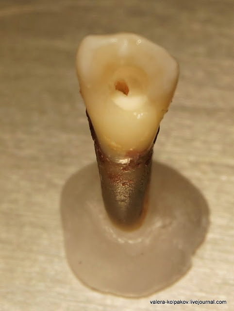 Как пломбируют корневые каналы в зубах. 