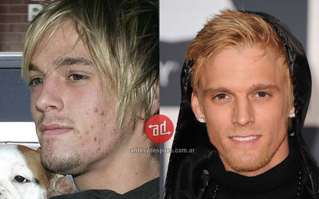 Photos of Aaron Carter with acne