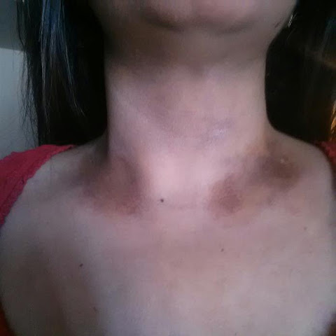 Dark spots on my neck - What is this?": Skin &amp; Beauty Community 