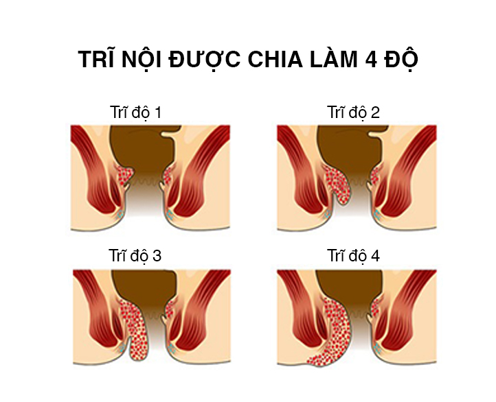 Minh họa 4 cấp độ bệnh trĩ nội thông qua đặc điểm búi trĩ