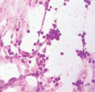 Equine "slow herpesvirus" cytopathic effect. Courtesy of A. Wayne Roberts.