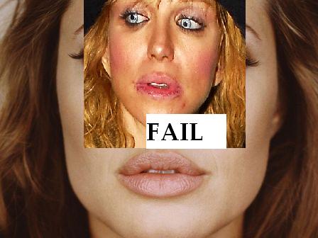 Courtney love lip injection fail