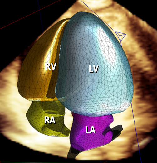 Ecocardiografia tridimensional (eco 3D) mostrando segmentação automatizada das câmaras cardíacas