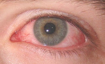 Mirtoplus Untuk Iridosiklitis Infeksi pada Mata
