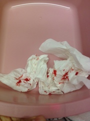 post double jaw surgery nose bleed