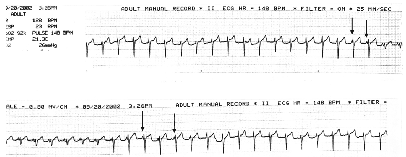 ECG rhythm strip recorded from an anesthetized cat showing accelerated idioventricular rhythm