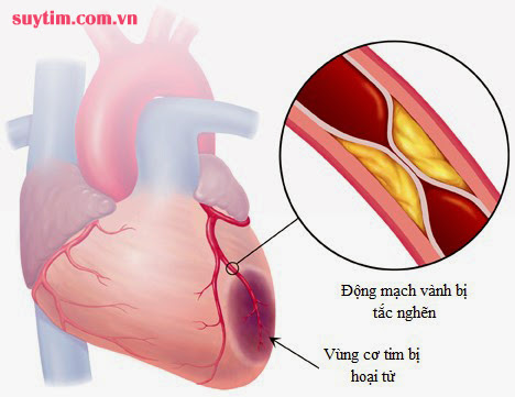 Tắc nghẽn động mạch vành gây nhồi máu cơ tim