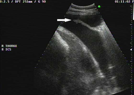 Sonogram of the ventral tip of the right lung in a horse with compression atelectasis obtained in the 8th intercostal space.