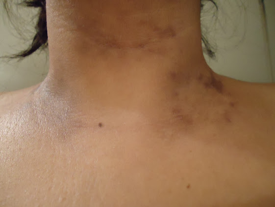 Dark Patch Of Skin On Breast