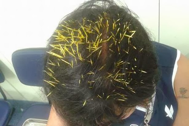 ブラジルで女性の頭にヤマアラシが落下。約２００本の針が頭に刺さる