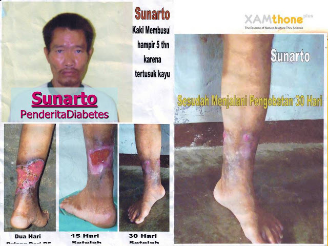  TESTIMONI KEHEBATAN XAMTHONE PLUS
