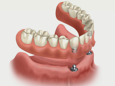 ¿Qué es una prótesis dental y cómo usarla correctamente?