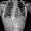 Scoliosis Solutions of Minnesota, LLC