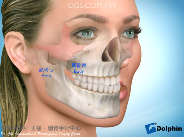 削骨手術,削顴骨,顴骨雕塑