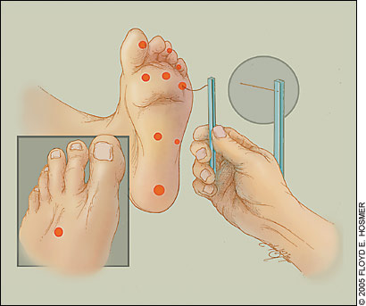 Diabetic Foot Exam – Stethopedia