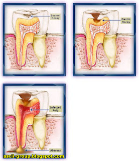 تسوس الأسنان - مراحل وأعراض وتشخيص وتوصيات وعلاج  Tooth-Decay