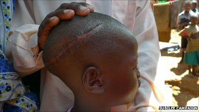 Niño mutilado en Uganda. ©BBC