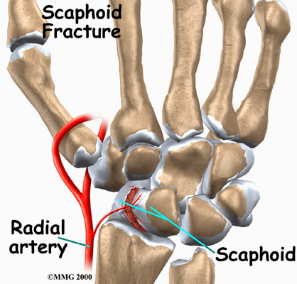 腕骨骨折 Carpal Fracture 小小整理網站smallcollation