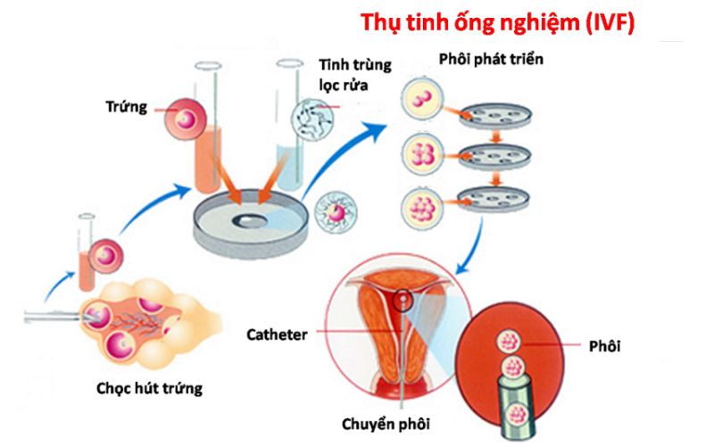 Phương pháp thụ tinh qua ống nghiệm (IVF)