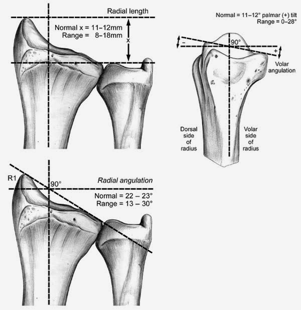 橈骨遠端骨折 Fracture Of The Distal Radius 小小整理網站smallcollation