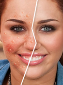 Celebrities with acne