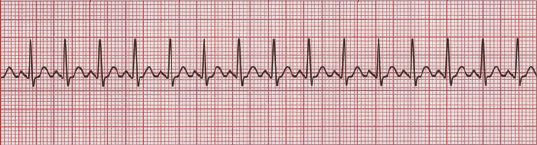 Ecg 3 What Is Sinus Tachycardia Health And Usmle Answers