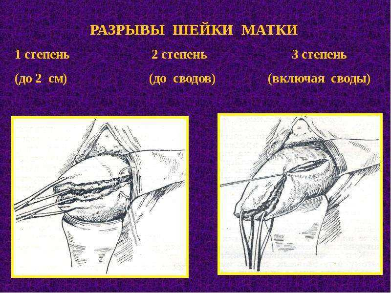 Степени разрыва матки