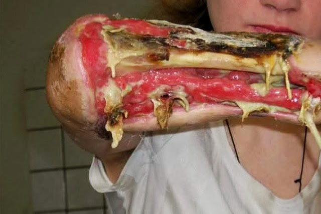 Krokodril, peligrosa droga que carcome la piel del adicto hasta dejar los huesos expuestos Kroko-1