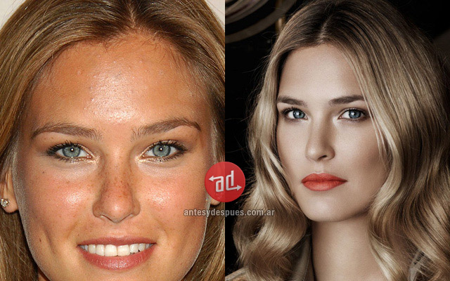 Photos of Bar Refaeli with acne