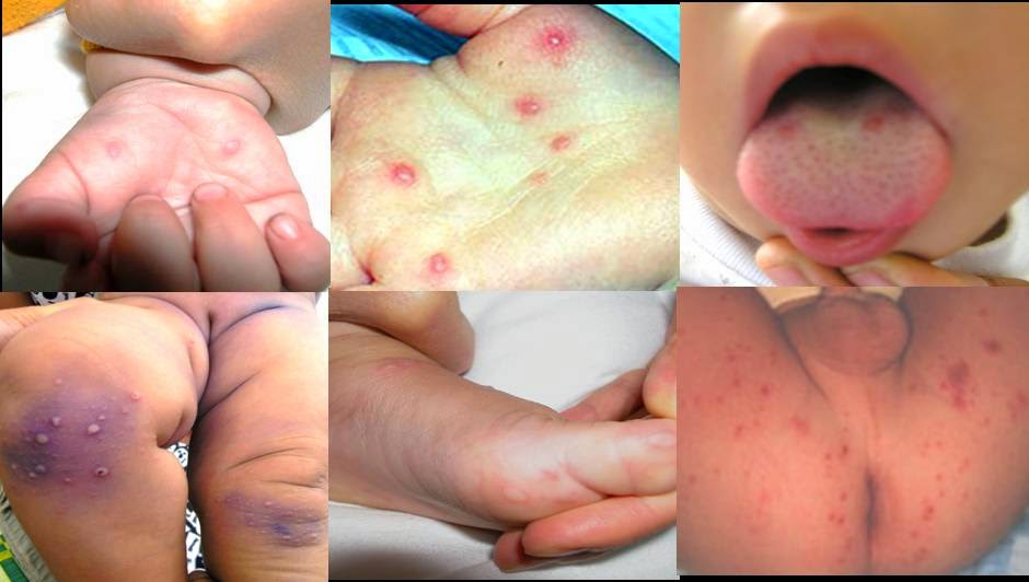 Bệnh tay chân miệng ở trẻ em có tái nhiễm hay không?