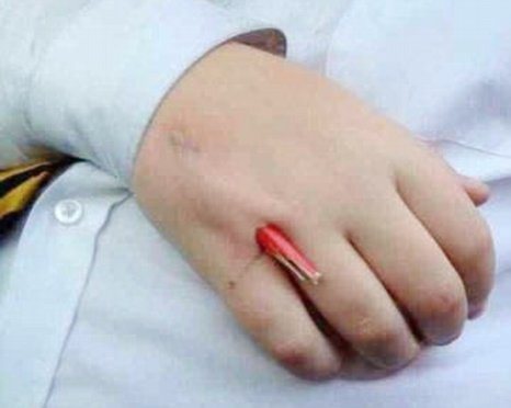 Effort Lab  Tangan Tertusuk Pensel Akibat Bergurau [2 gambar]