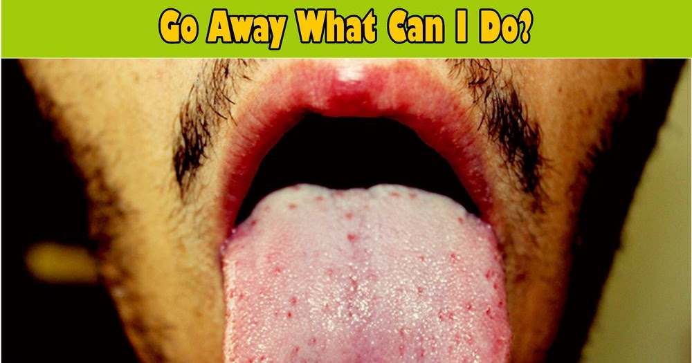 ORAL HEALTH: My White Tongue Won't Go Away What can I Do?