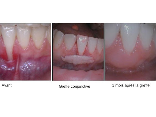 Dr Escaut André - Parodontiste - parodontologie, implants dentaires, couronnes dentaires