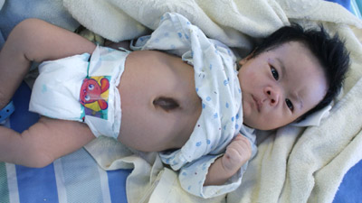 Baby Born With Heart Outside Body | Miracle Babies Born Alive