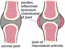 Artritis en las rodillas síntomas