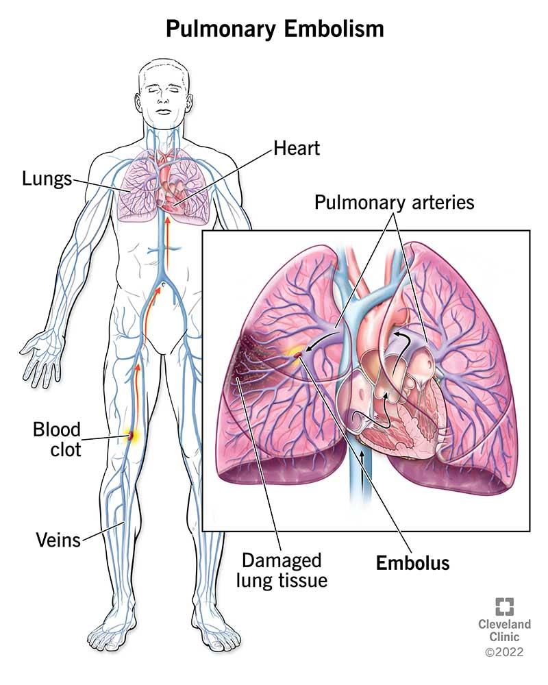 Pulmonary Embolism (PE): Symptoms, Signs & Treatment